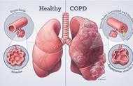 詳解慢阻肺二氧化碳瀦留：容易導致急性加重